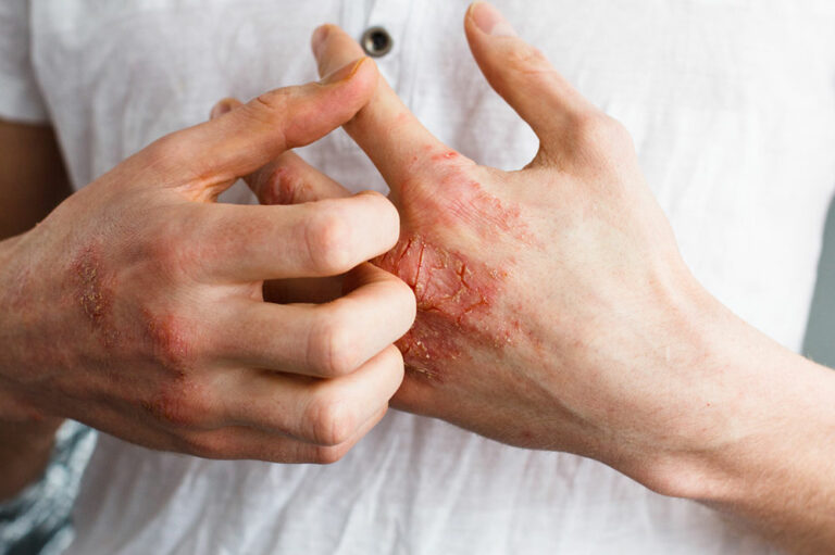 Things You Need to Know about Eczema