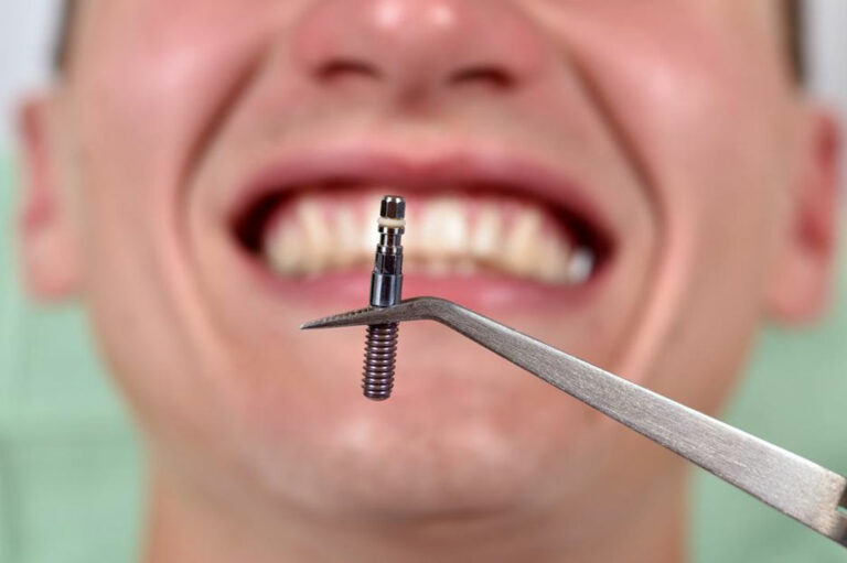 Things you should know about dental implants costs