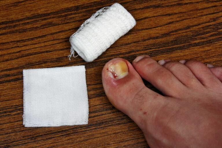 Tips to Cure and Prevent Toenail Fungus