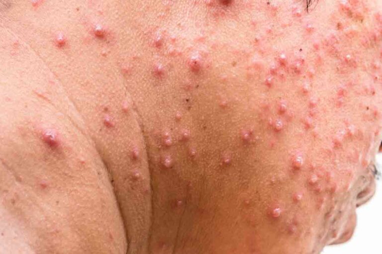 Tips to Treat Shingles Rash