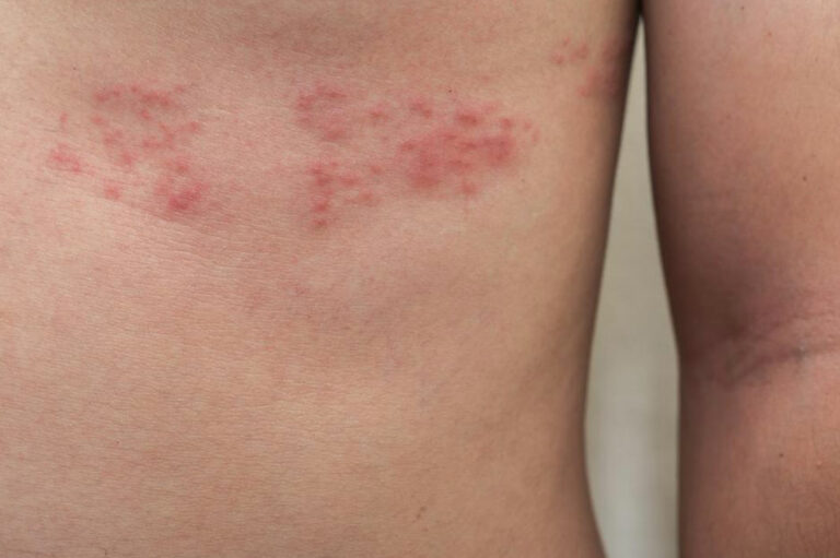 Top 3 Simple Treatments for Shingles You Need to Know