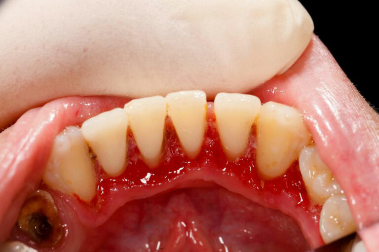 Top 8 natural treatments for gum disease