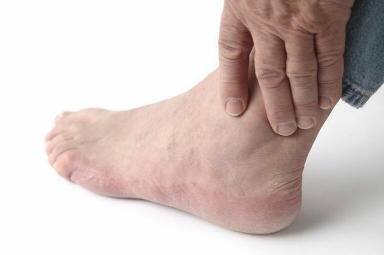 Top Causes of Swollen Ankles