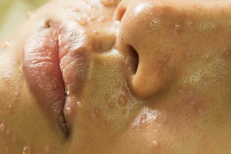 Treat Rosacea With These Natural Medicines and Remedies