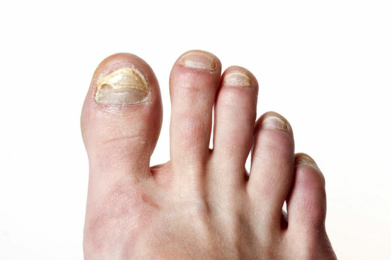 Tried and Tested Natural Cure for Toenail Fungus