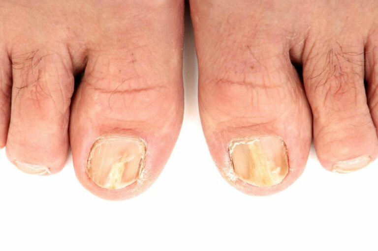 Try These 5 Ways to Effectively Treat Toenail Fungus