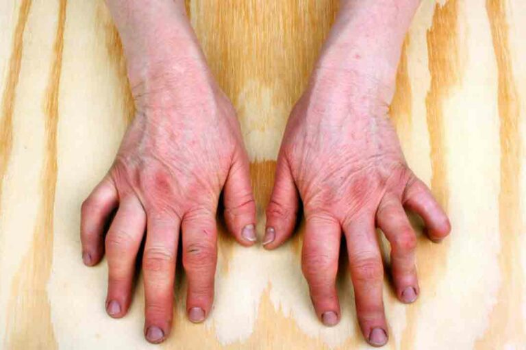 Understanding the Symptoms of Rheumatoid Arthritis