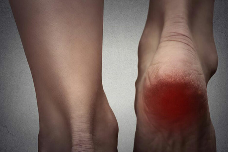 Understanding Burning Foot Pain and its Treatment Options