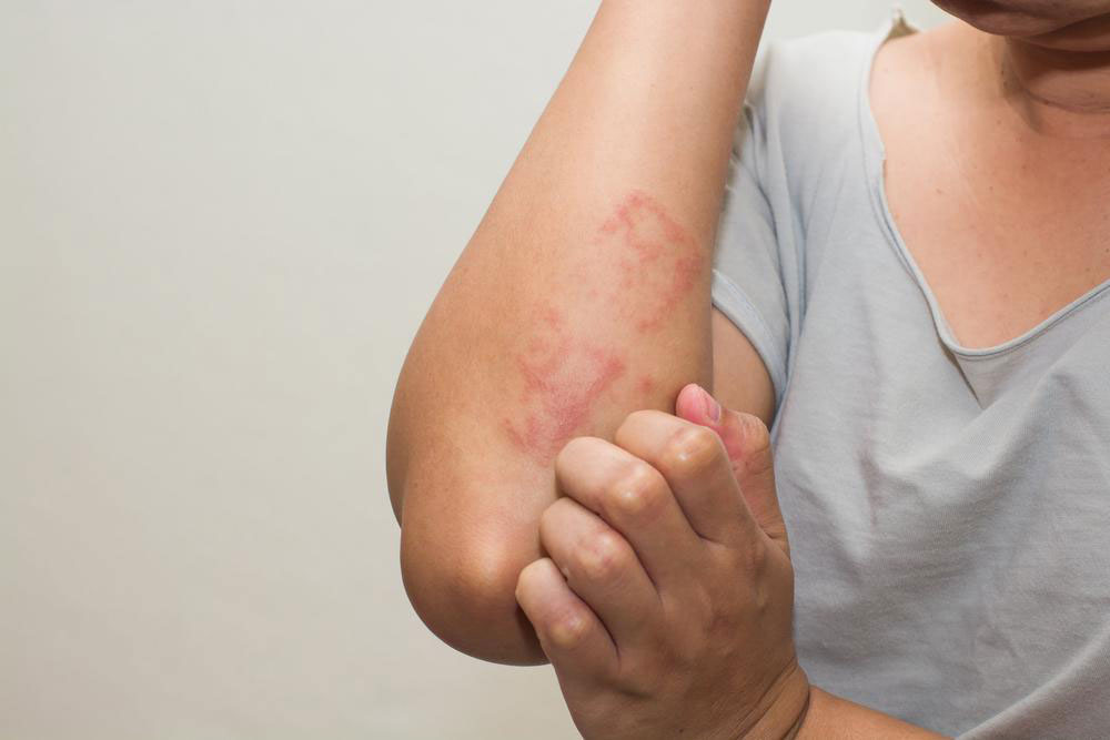 Various Effective Treatment Options For Atopic Dermatitis