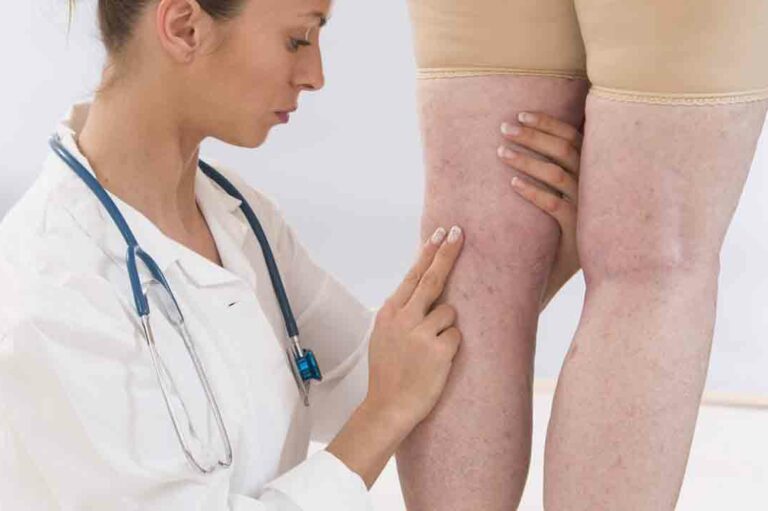 Various Symptoms of Deep Vein Thrombosis Worth Knowing