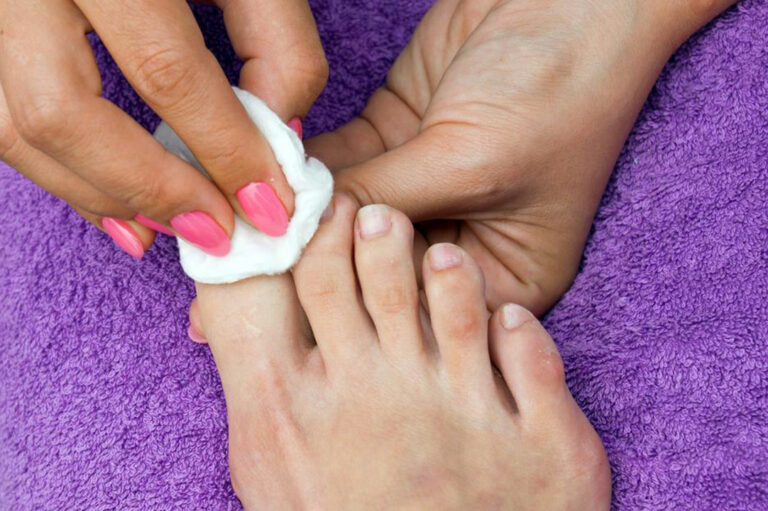 Ways to Cure Nail Fungus