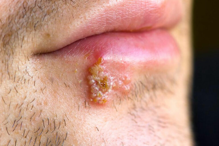 Ways to Get Rid of Cold Sores