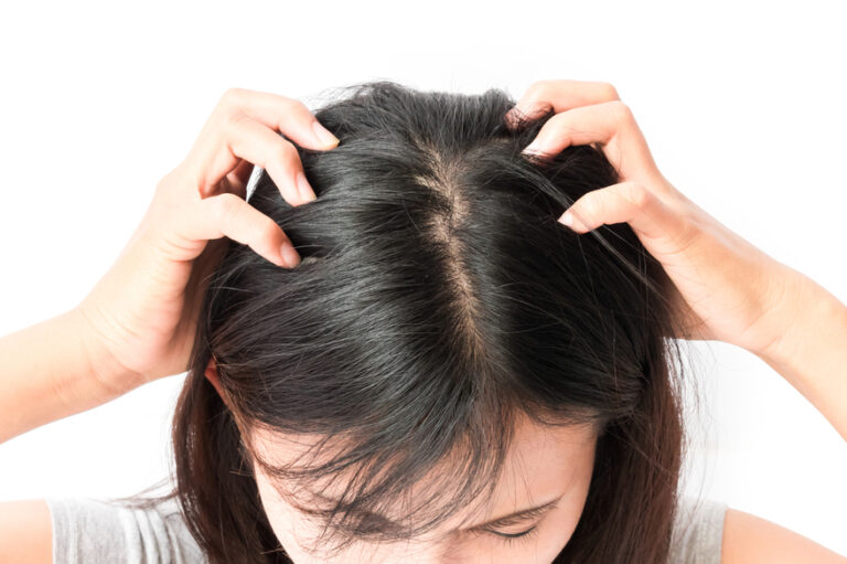 What To Know About Treating An Itchy Scalp