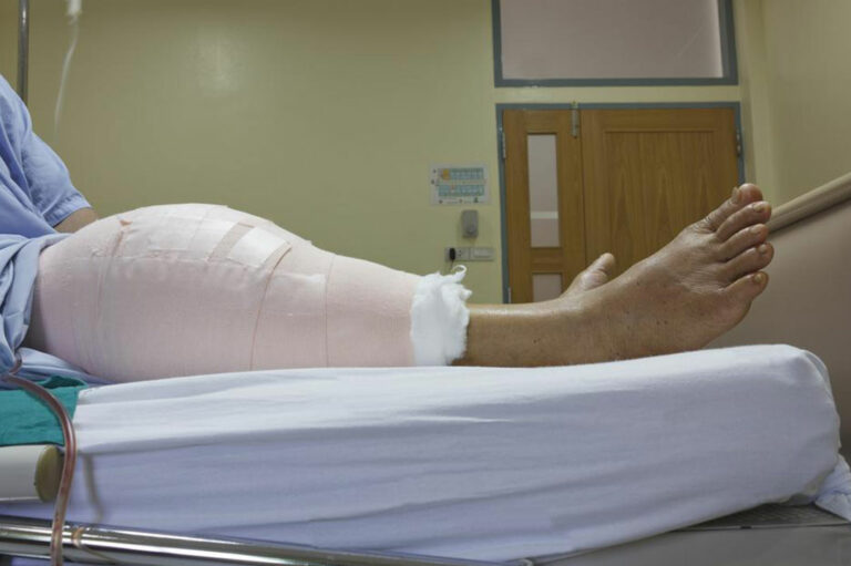 What You Need To Know About Knee Replacement Surgery