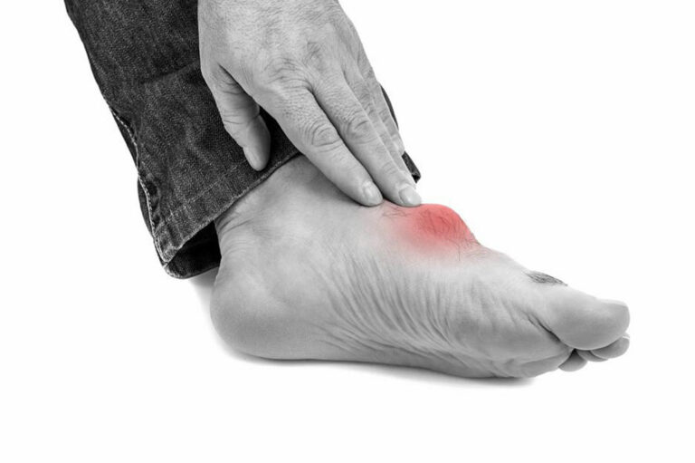 What You Need to Know about Gout