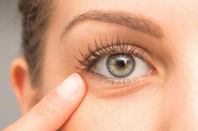 10 Tips to Remove Under-Eye Bags