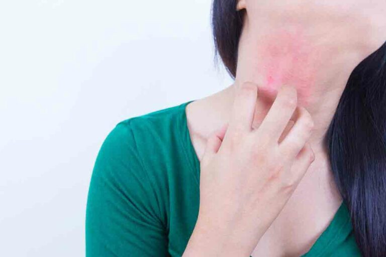 10 over-the-counter treatments for eczema that offer better results