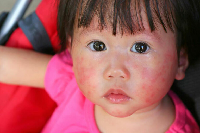 4 useful tips to treatment of atopic dermatitis in children