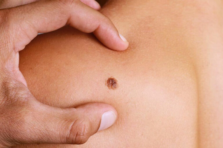 4 common types of melanoma and their treatment options