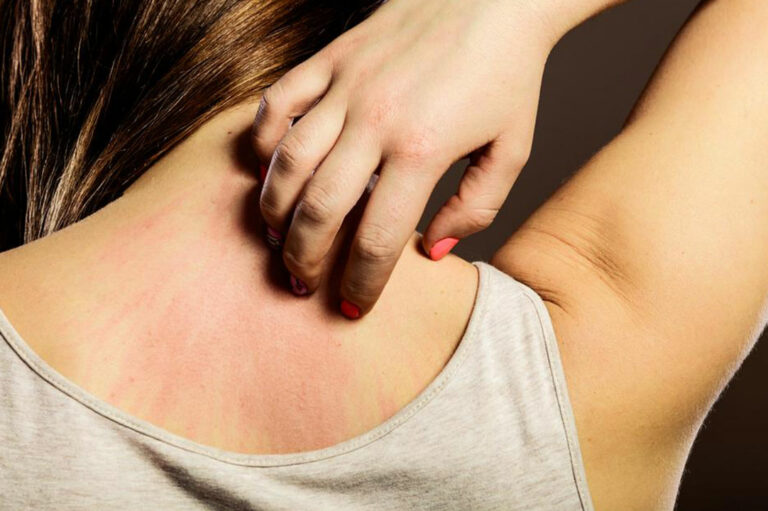 4 common causes that lead to eczema