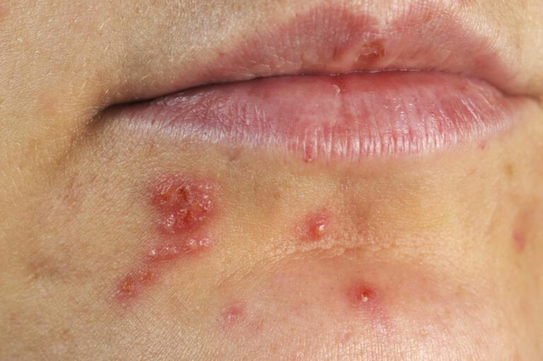 4 effective ways to treat herpes