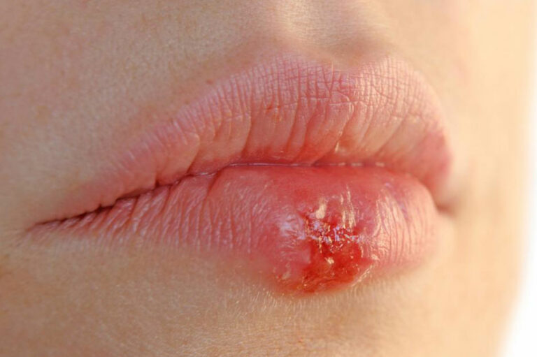 4 effective home remedies for herpes