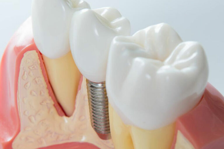 4 practical tips to maintain dental implants for seniors