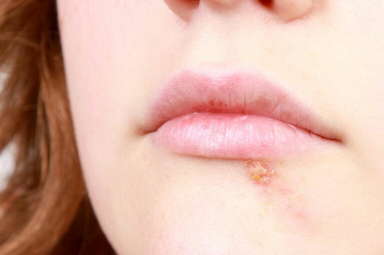 5 useful home remedies to get relief from cold sores