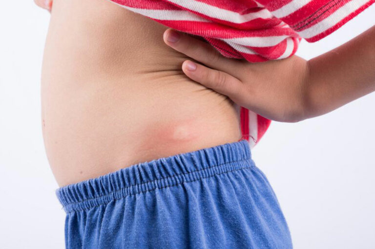 5 Useful Things to Know about Hidradenitis Suppurativa