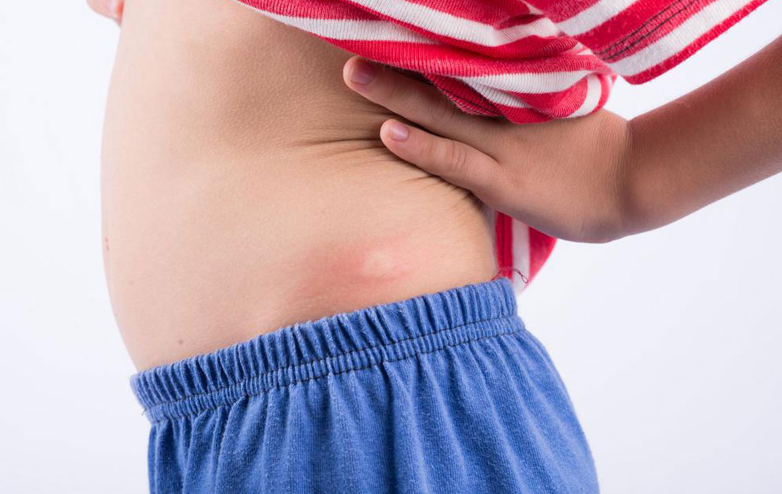 5 Useful Things to Know about Hidradenitis Suppurativa