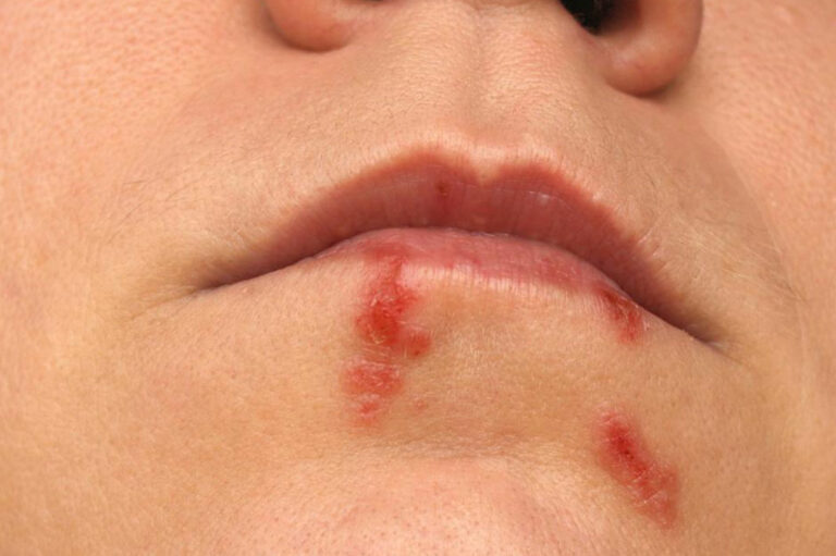 5 natural ways to deal with cold sore