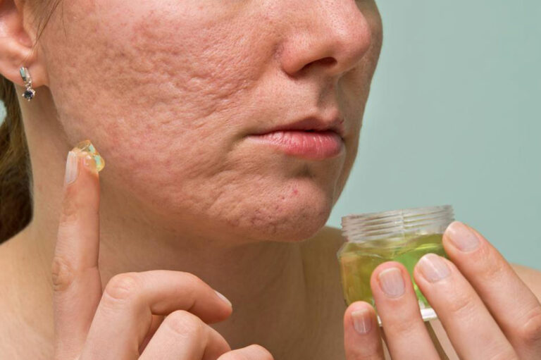 6 useful tips to treat acne scars, marks, and blemishes