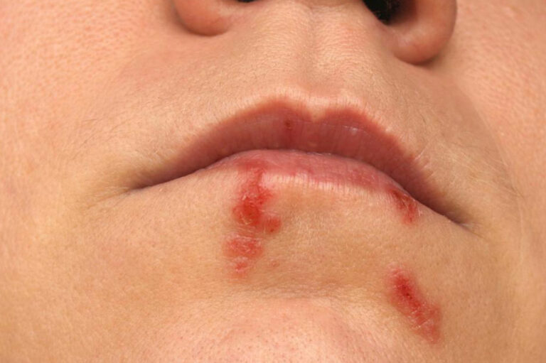 6 Effective Remedies for Treating Cold Sores