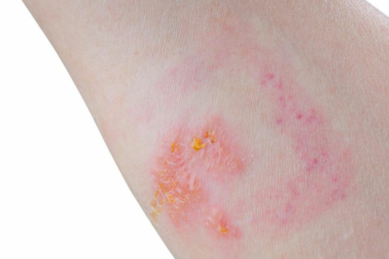 6 Home Remedies for Treating Skin Rashes