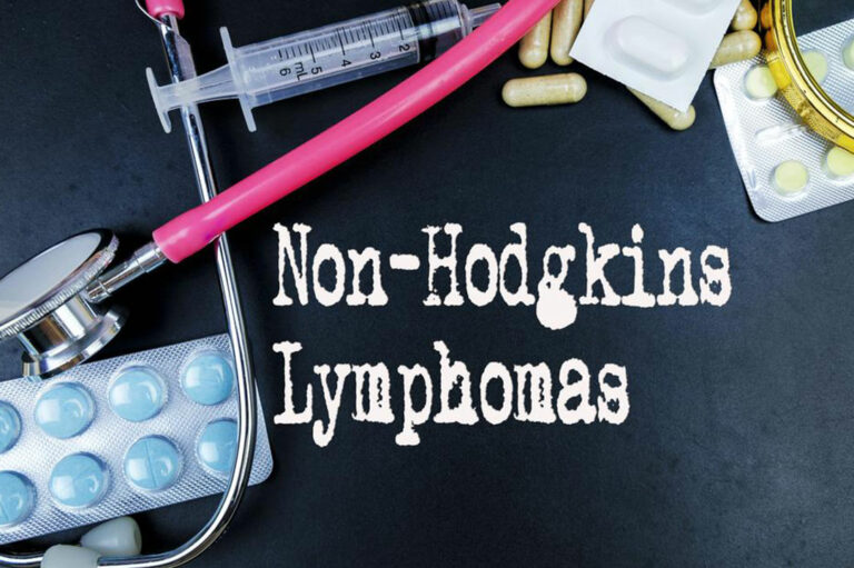 6 common risk factors for Non-Hodgkin lymphoma