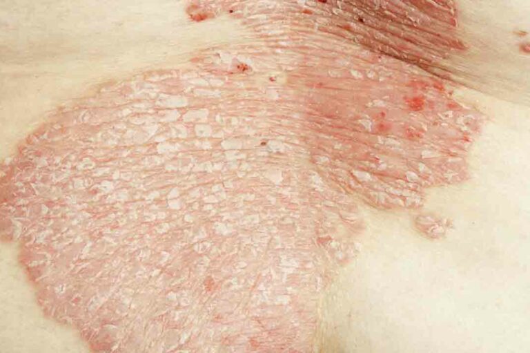 7 Common Types of Eczema