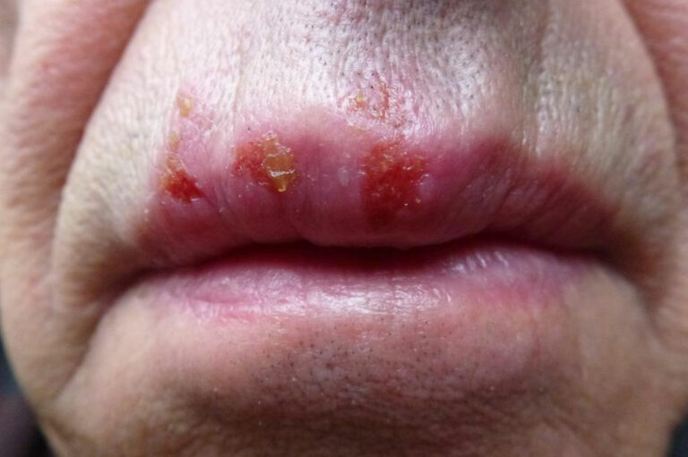 7 myths about herpes