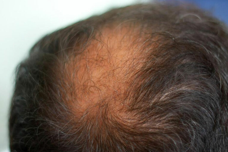 8 Effective Home Remedies for Thinning Hair