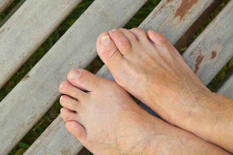 9 Simple Home Remedies to Cure Toenail Fungus