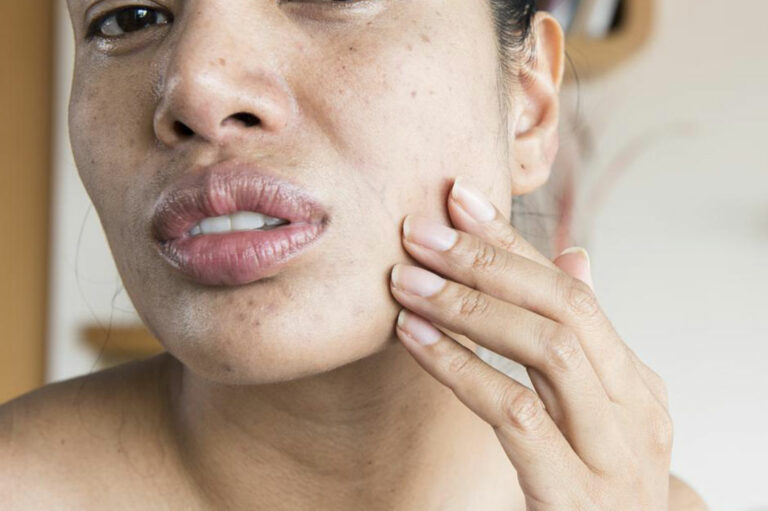 9 Symptoms of Lupus Women Should Know About